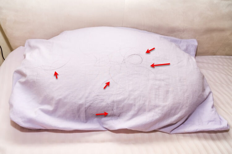 Image of a pillow and all the hair you may find after you've slept. This could be a sign of hair loss. 