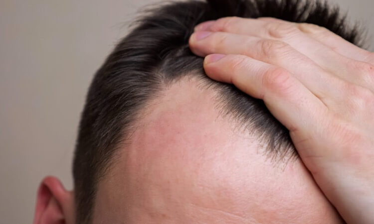 Dealing with Bald Spots and Male Pattern Baldness | Happy Head
