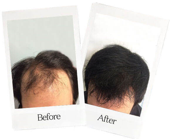 Årligt Ups stemme Topical Finasteride for Hair Loss | Happy Head