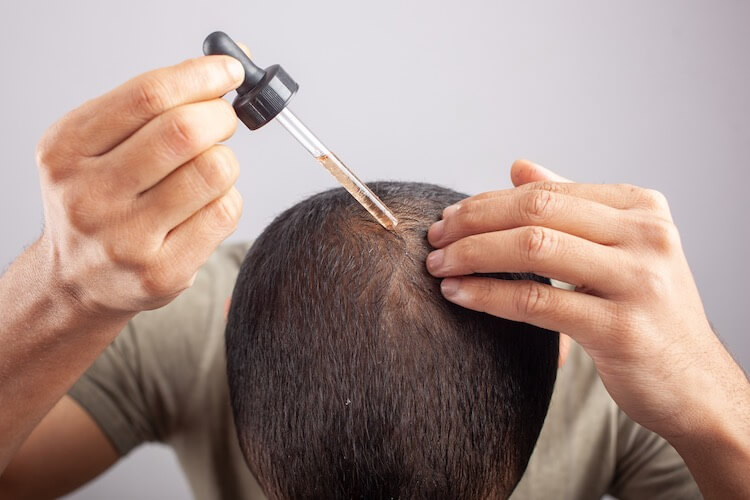 Minoxidil or Finasteride: Which Treatment is Better? | Happy Head