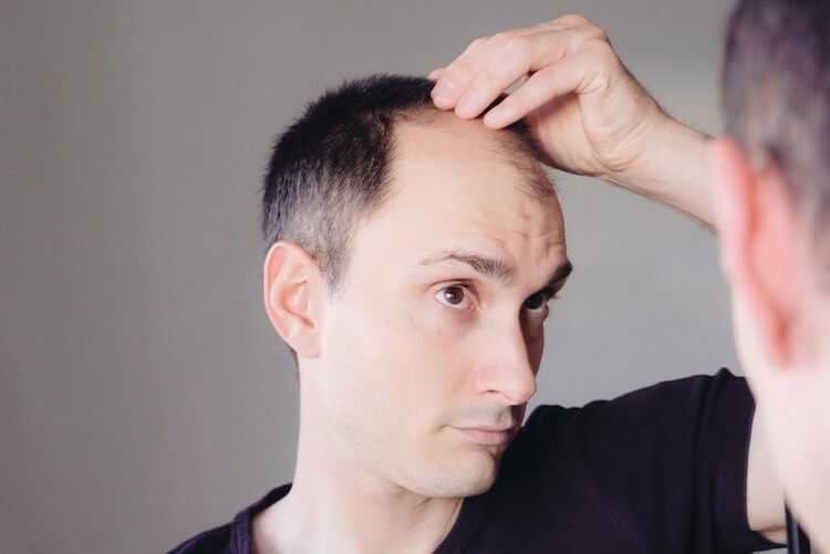 Is male pattern hair loss inherited? Find out everything you need to know about your hair loss with tips from our Happy Head board-certified dermatologists. 