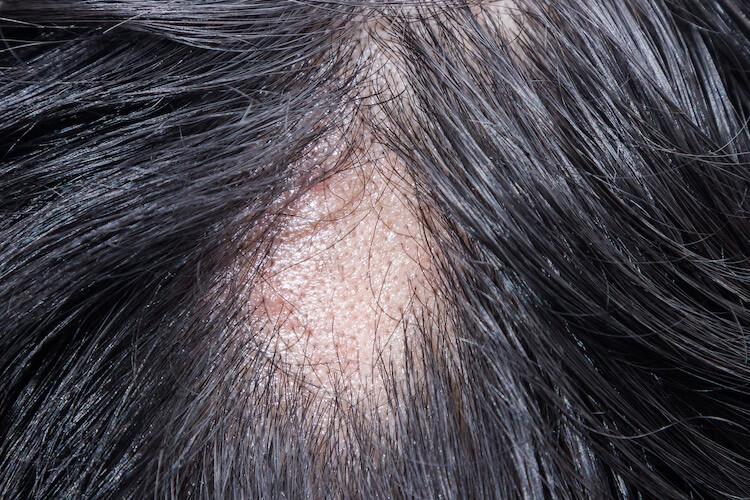 Here's an example of what patchy balding looks like for someone experiencing patchy hair loss. Happy Head hair loss and regrowth specialists take a deeper dive into the disorder to help you understand what signs to look for and how to treat it with prescription-grade home treatments by Happy Head dermatologists. 