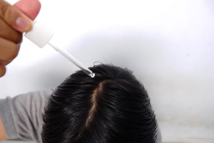 When choosing a hair regrowth treatment using Minoxidil, you might wonder whether the foam or liquid version is right for you. Dr. Ben Behnam always recommends liquid because foam has a lot of air pockets and gets trapped in your hair. This is an image of a client using a liquid for of Minoxidil with a dropper or pipette that has exact measurements on the glass tube for accuracy. 